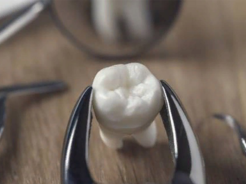 Причины, по которым необходимо удаление зуба!